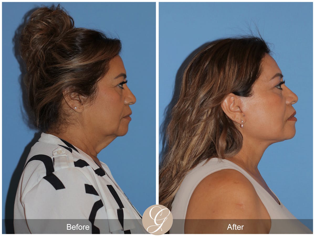 Preservation Facelift Before & After Gallery - Patient 627169 - Image 4