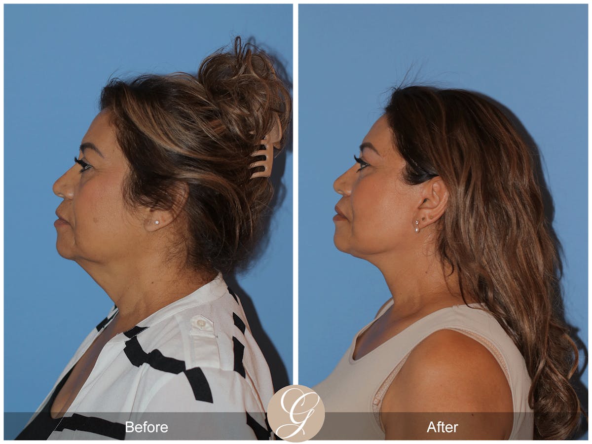 Preservation Facelift Before & After Gallery - Patient 627169 - Image 5