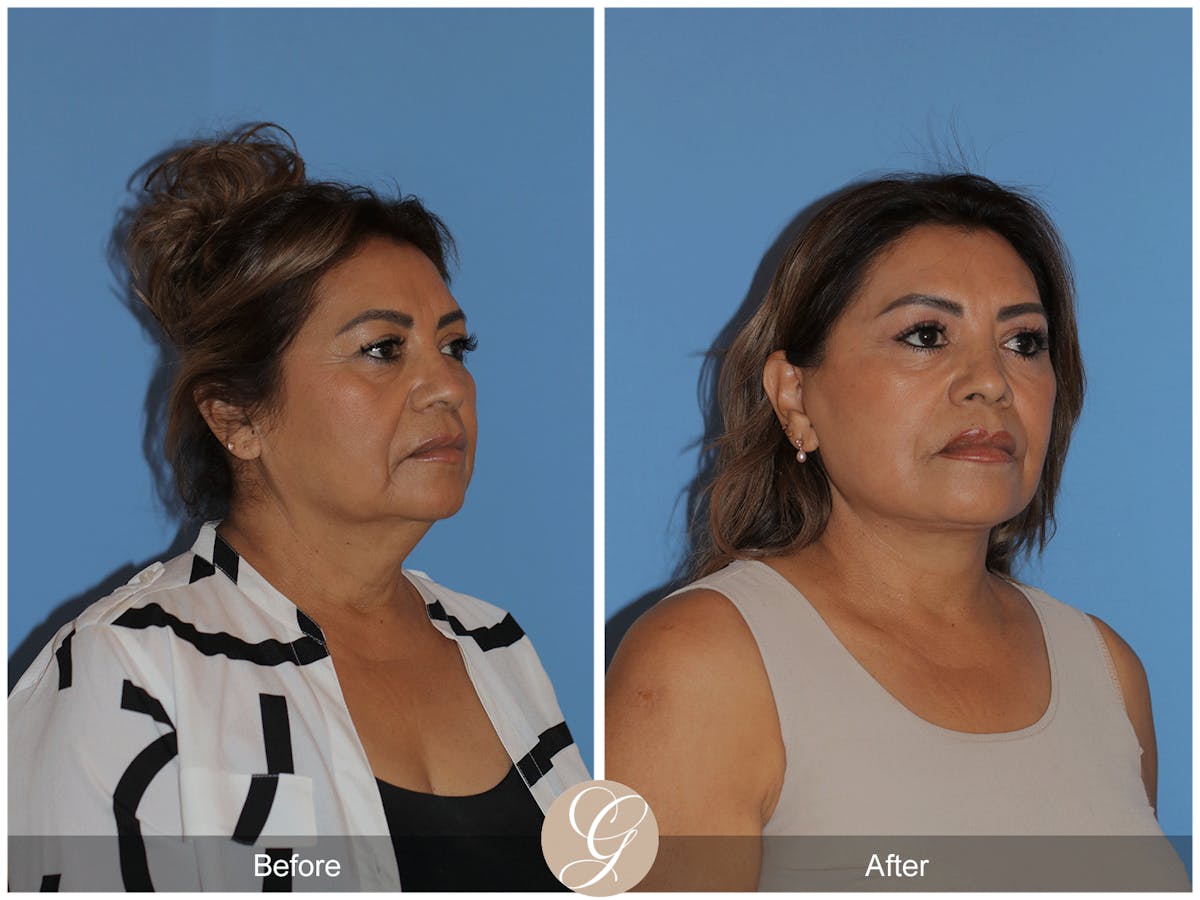 Preservation Facelift Before & After Gallery - Patient 627169 - Image 8