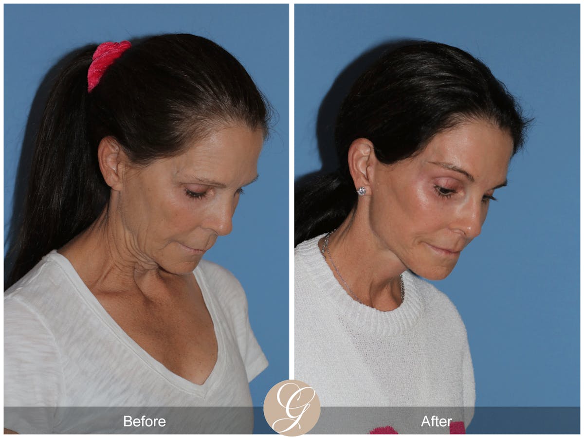 Preservation Facelift Before & After Gallery - Patient 421936 - Image 9
