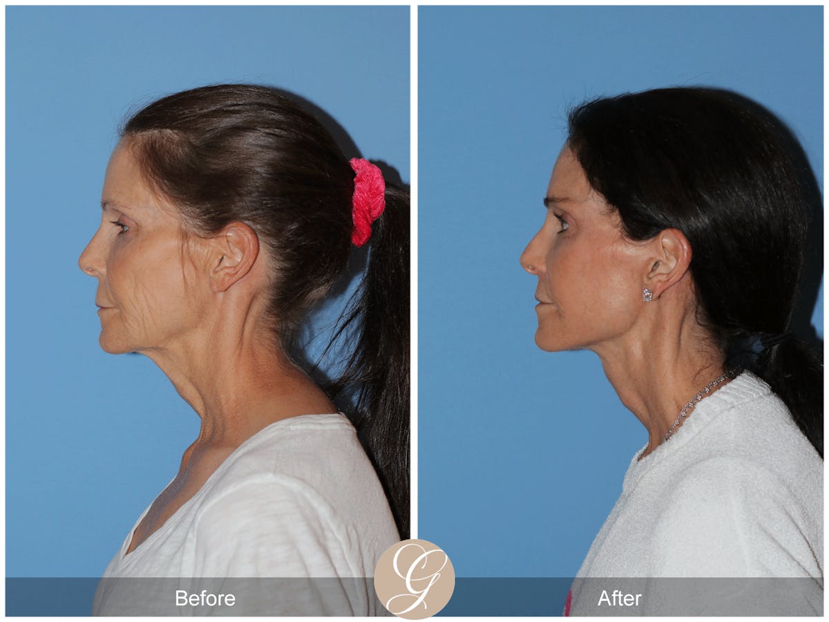 Preservation Facelift Before & After Gallery - Patient 421936 - Image 10