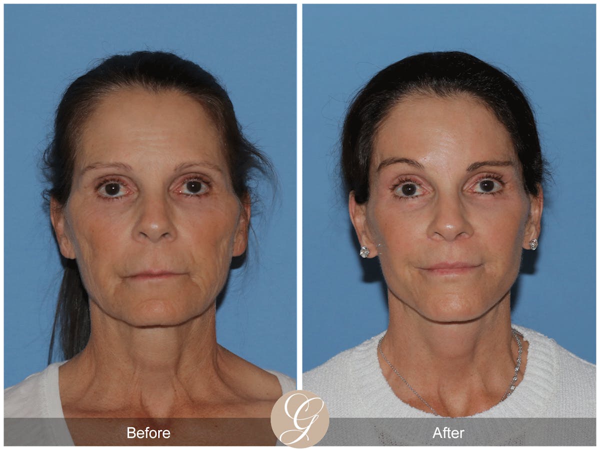 Preservation Facelift Before & After Gallery - Patient 421936 - Image 1