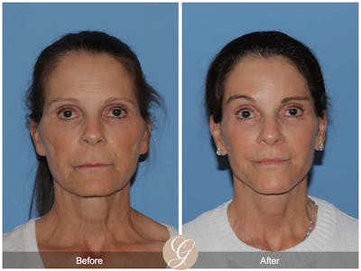Preservation Facelift Before & After Gallery - Patient 421936 - Image 1