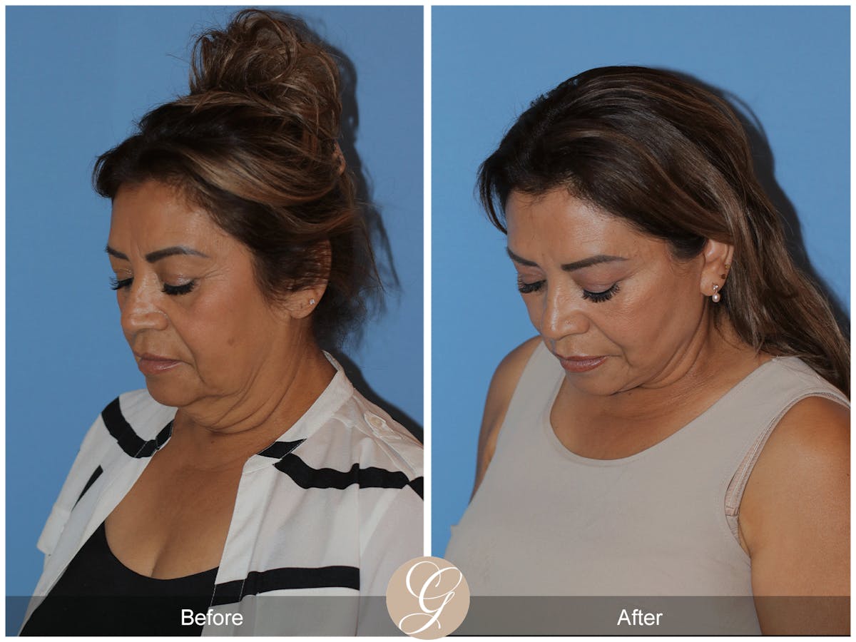 Preservation Facelift Before & After Gallery - Patient 627169 - Image 3