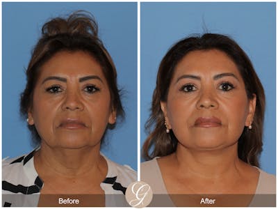 Preservation Facelift Before & After Gallery - Patient 627169 - Image 1