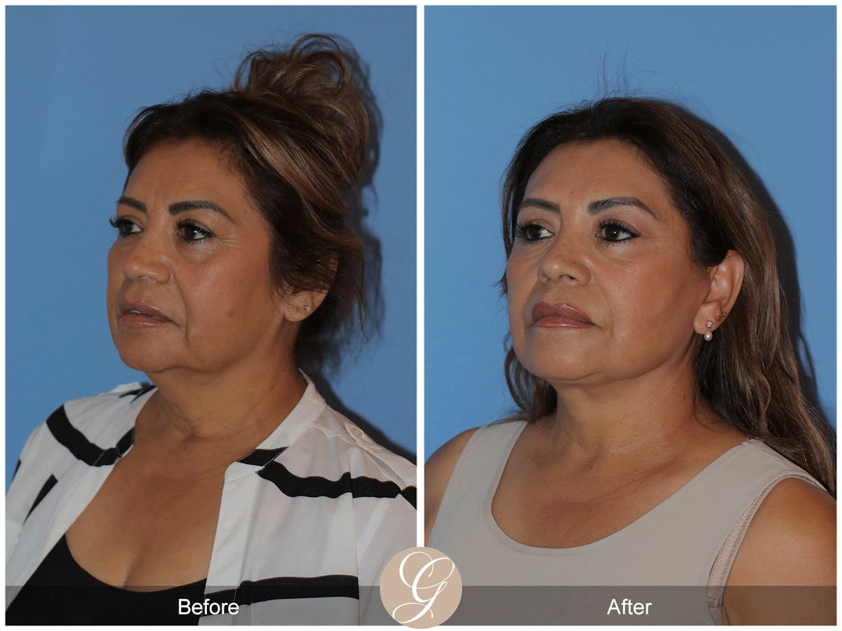 Preservation Facelift Before & After Gallery - Patient 627169 - Image 6