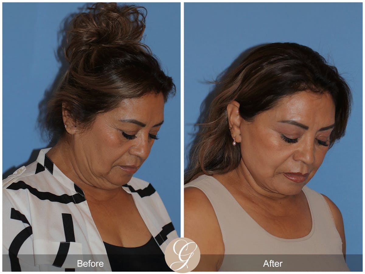 Preservation Facelift Before & After Gallery - Patient 627169 - Image 9