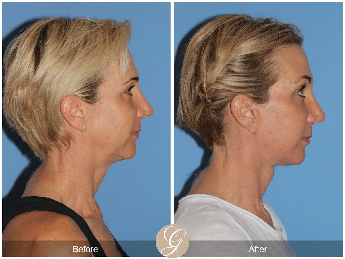 Preservation Facelift Before & After Gallery - Patient 312003 - Image 7
