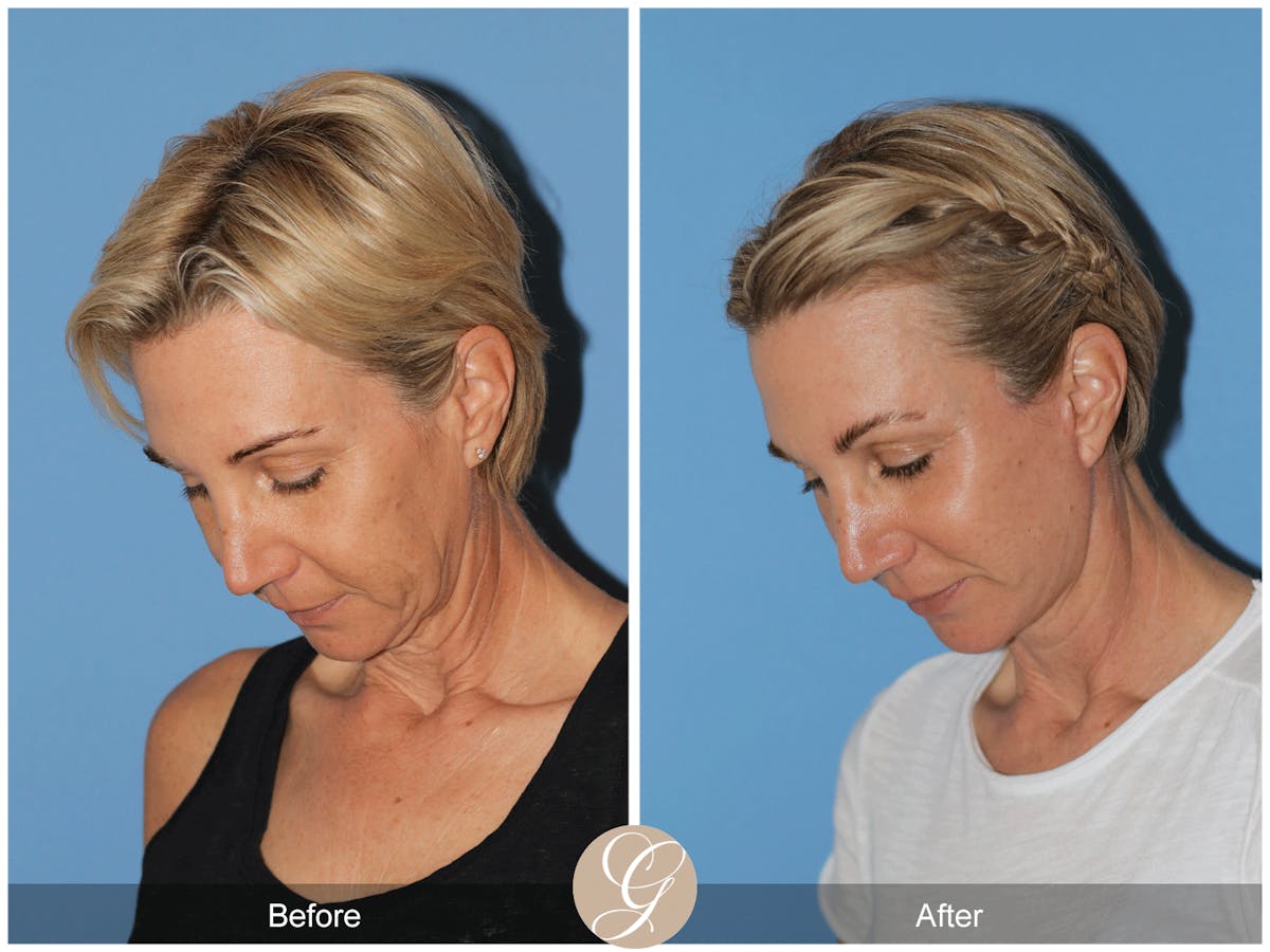Preservation Facelift Before & After Gallery - Patient 312003 - Image 5