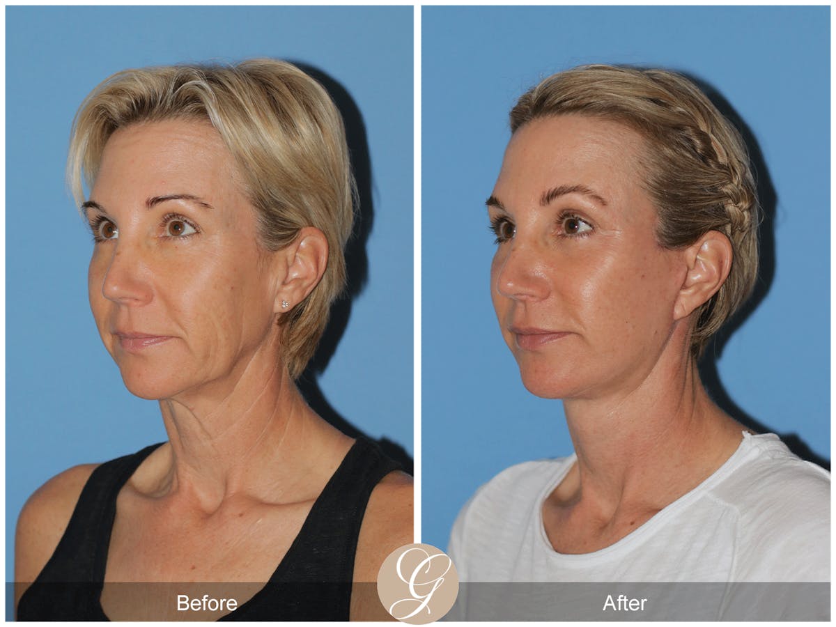 Preservation Facelift Before & After Gallery - Patient 312003 - Image 6
