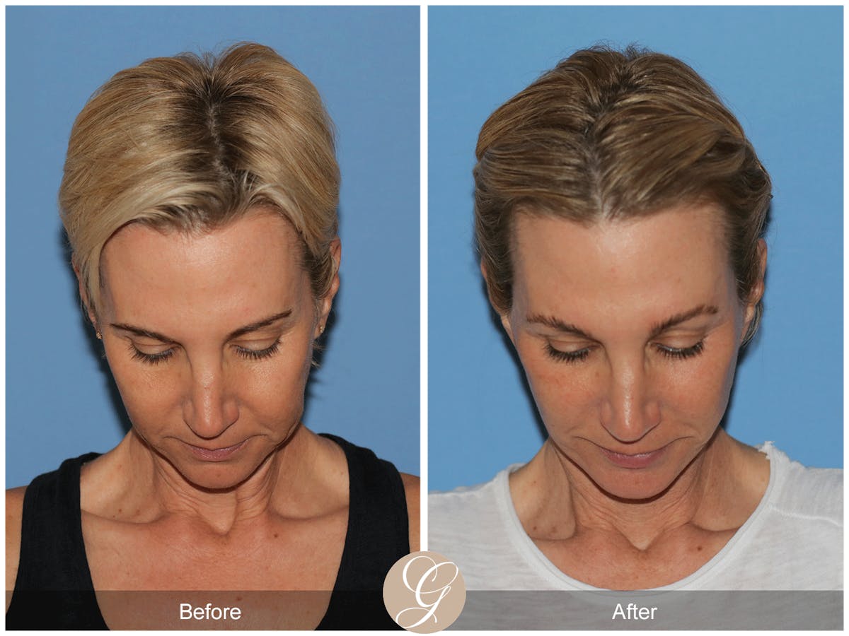 Preservation Facelift Before & After Gallery - Patient 312003 - Image 2