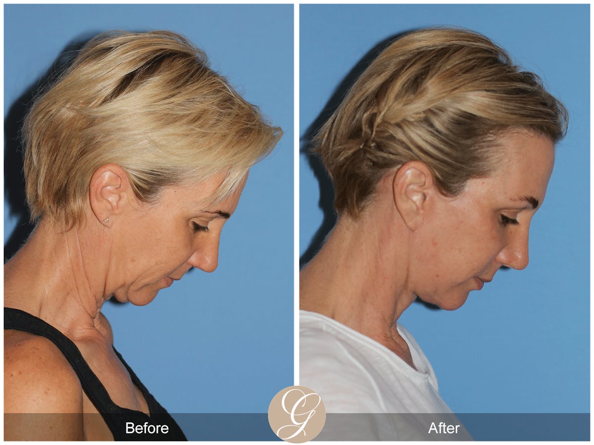 Preservation Facelift Before & After Gallery - Patient 312003 - Image 3
