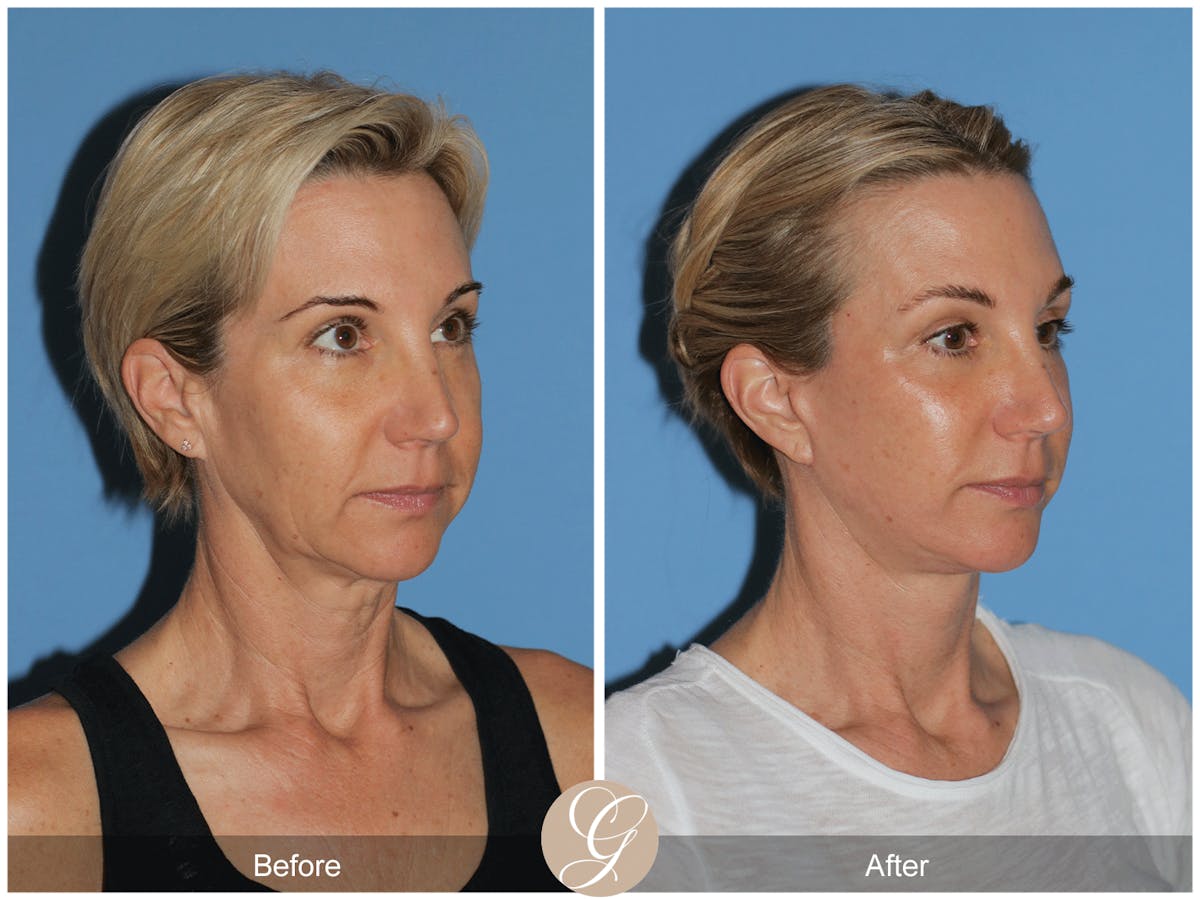 Preservation Facelift Before & After Gallery - Patient 312003 - Image 4