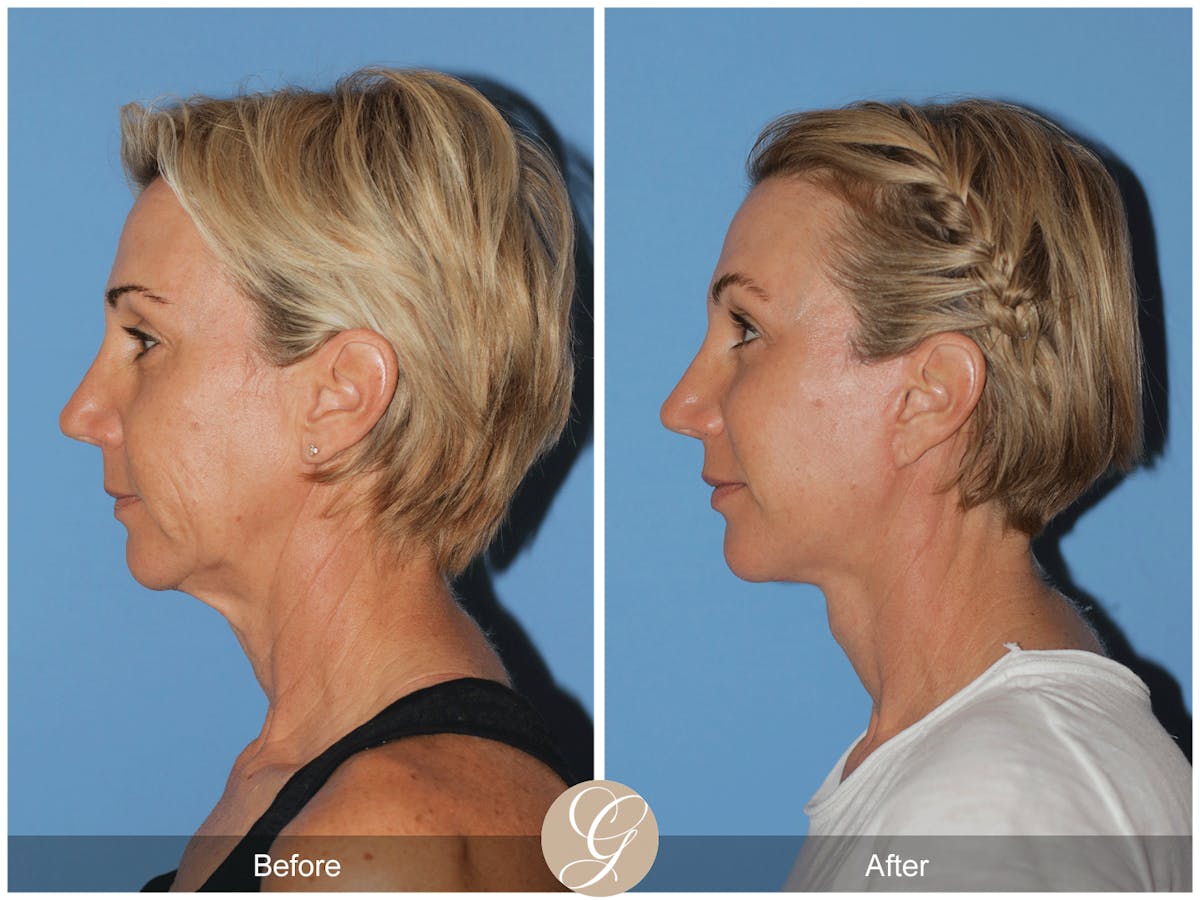 Preservation Facelift Before & After Gallery - Patient 312003 - Image 10