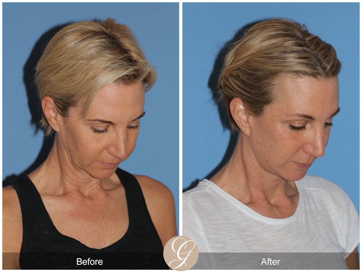 Preservation Facelift Before & After Gallery - Patient 312003 - Image 9