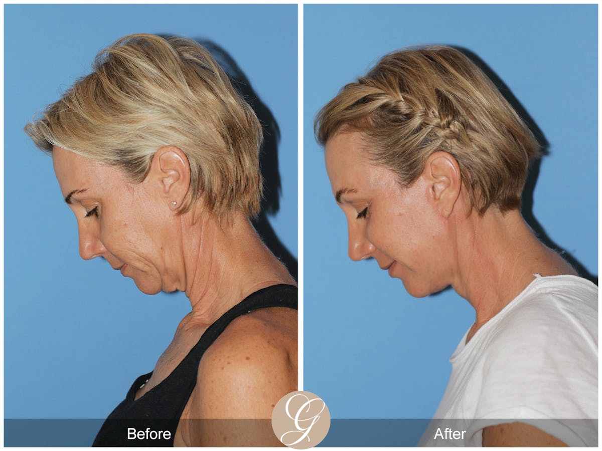 Preservation Facelift Before & After Gallery - Patient 312003 - Image 11