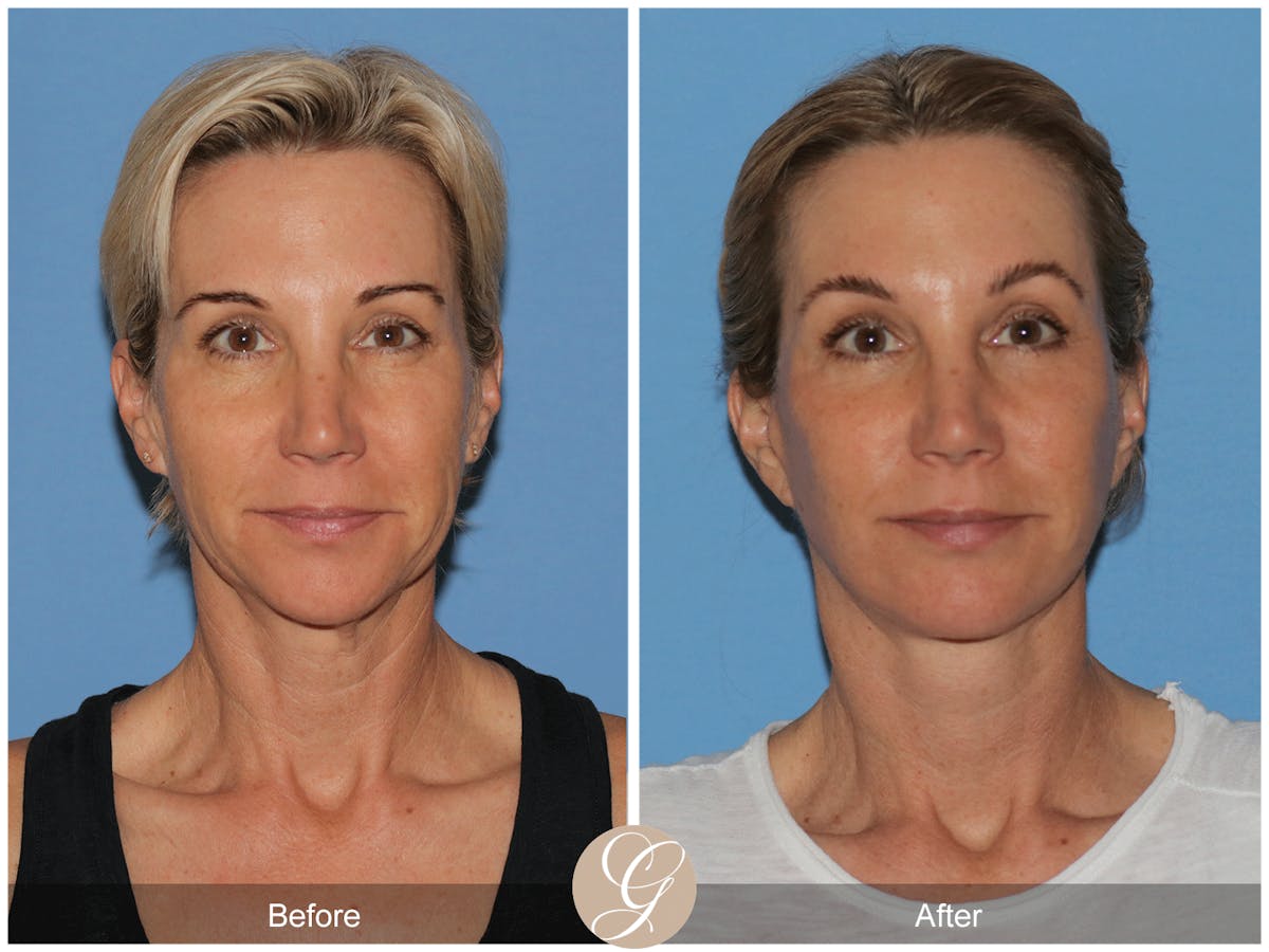 Preservation Facelift Before & After Gallery - Patient 312003 - Image 8