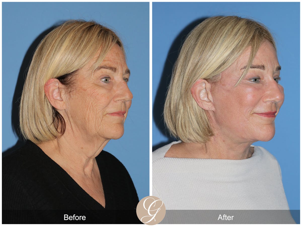 Preservation Facelift Before & After Gallery - Patient 332754 - Image 4