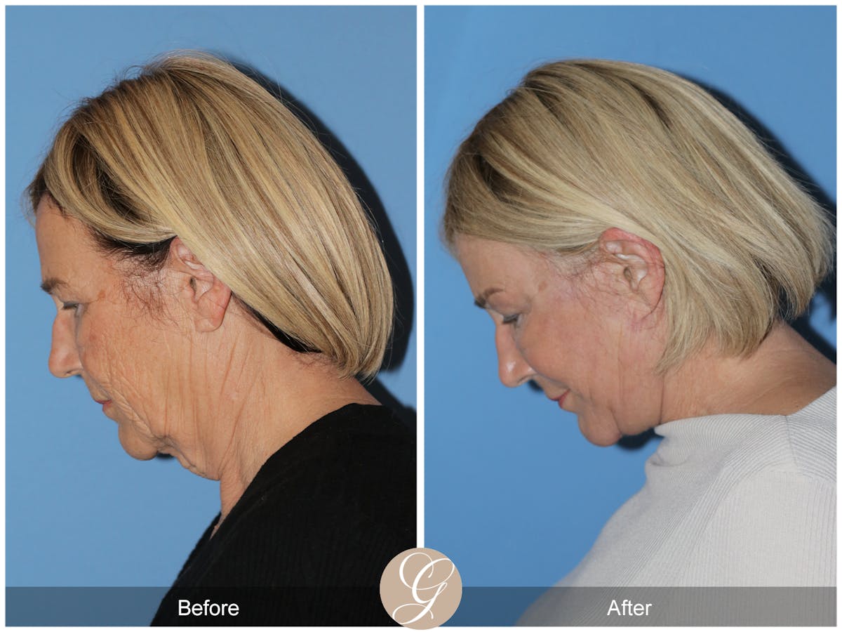 Preservation Facelift Before & After Gallery - Patient 332754 - Image 6