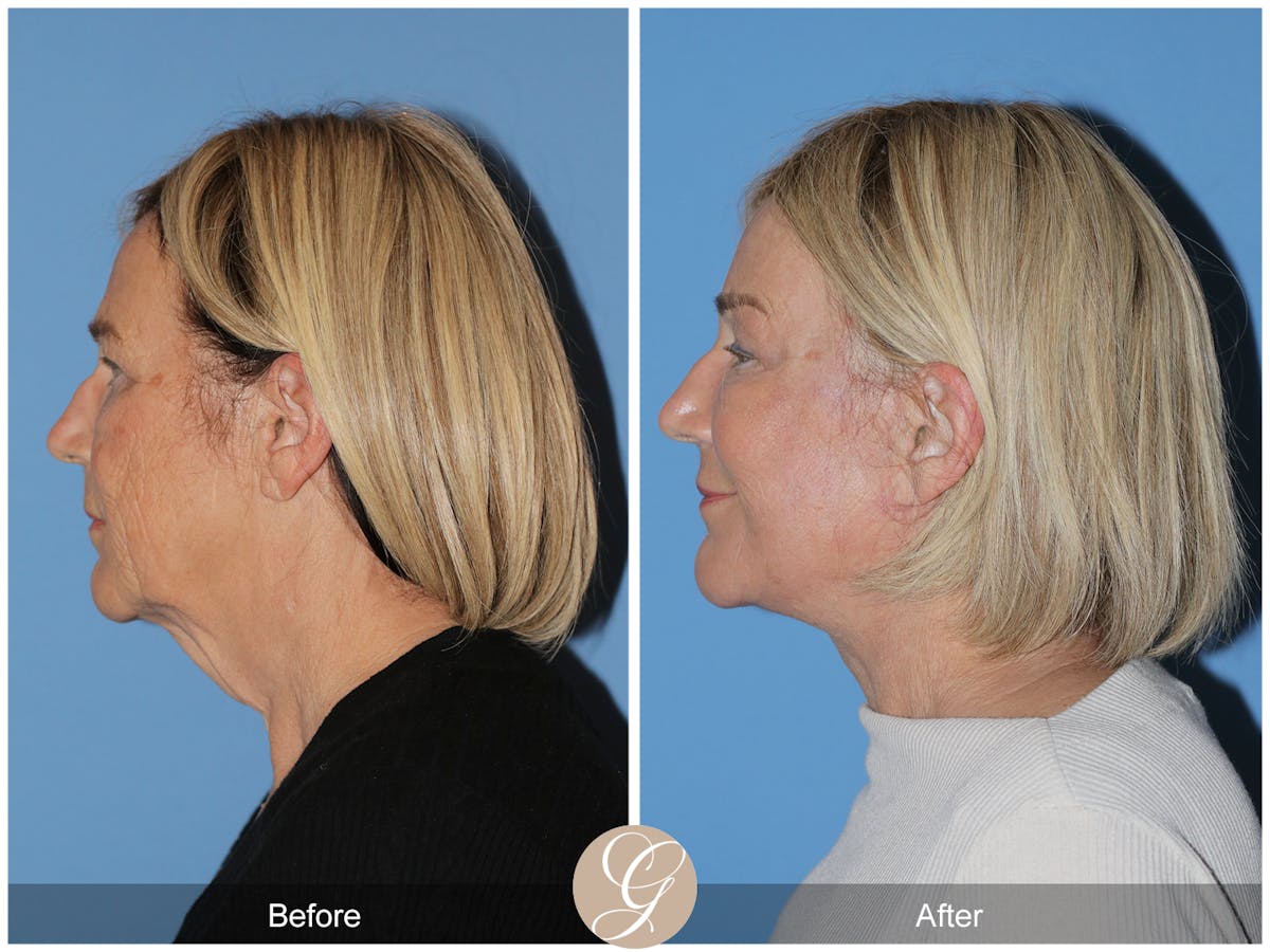 Preservation Facelift Before & After Gallery - Patient 332754 - Image 5