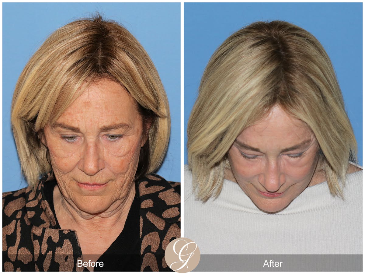 Preservation Facelift Before & After Gallery - Patient 332754 - Image 2