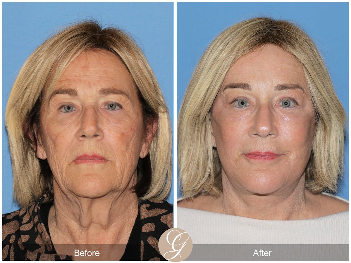 Preservation Facelift Before & After Gallery - Patient 332754 - Image 1