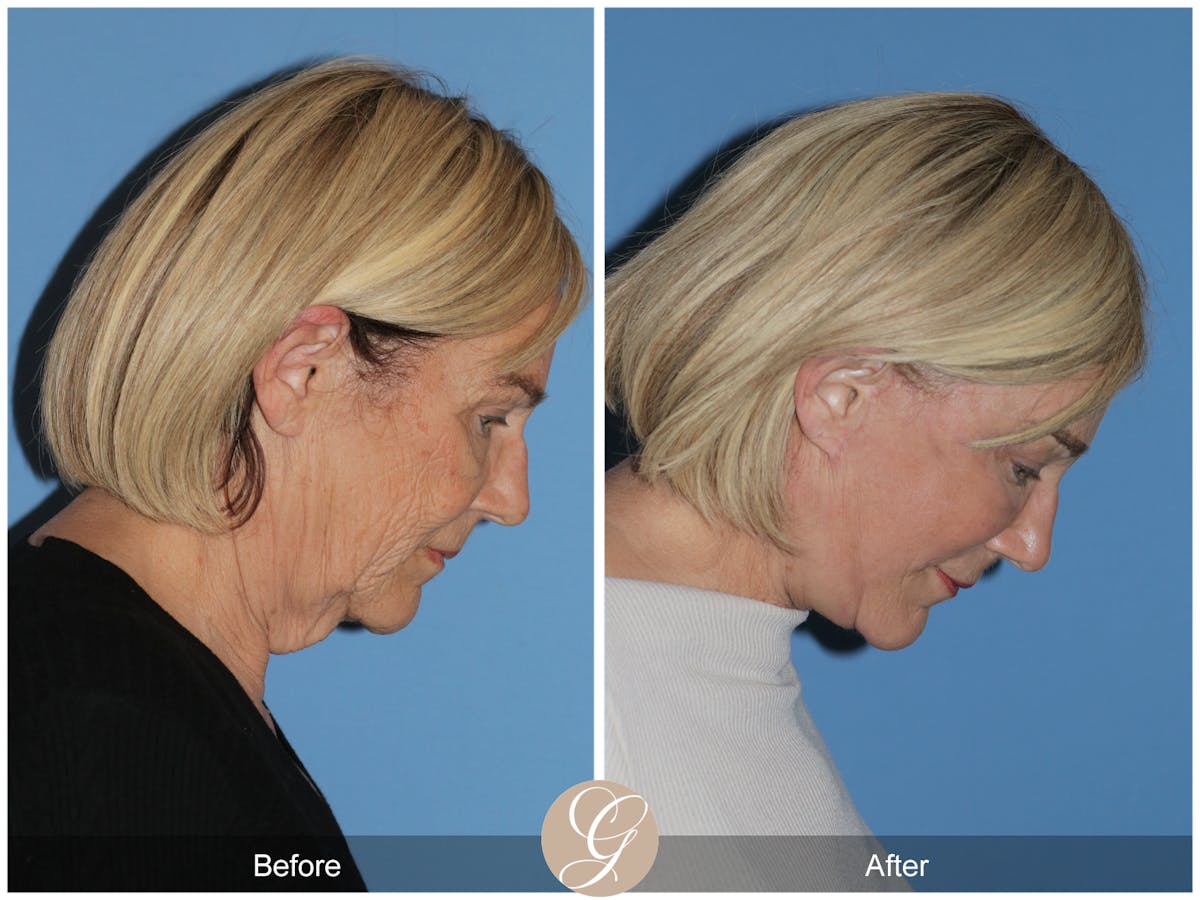 Preservation Facelift Before & After Gallery - Patient 332754 - Image 3