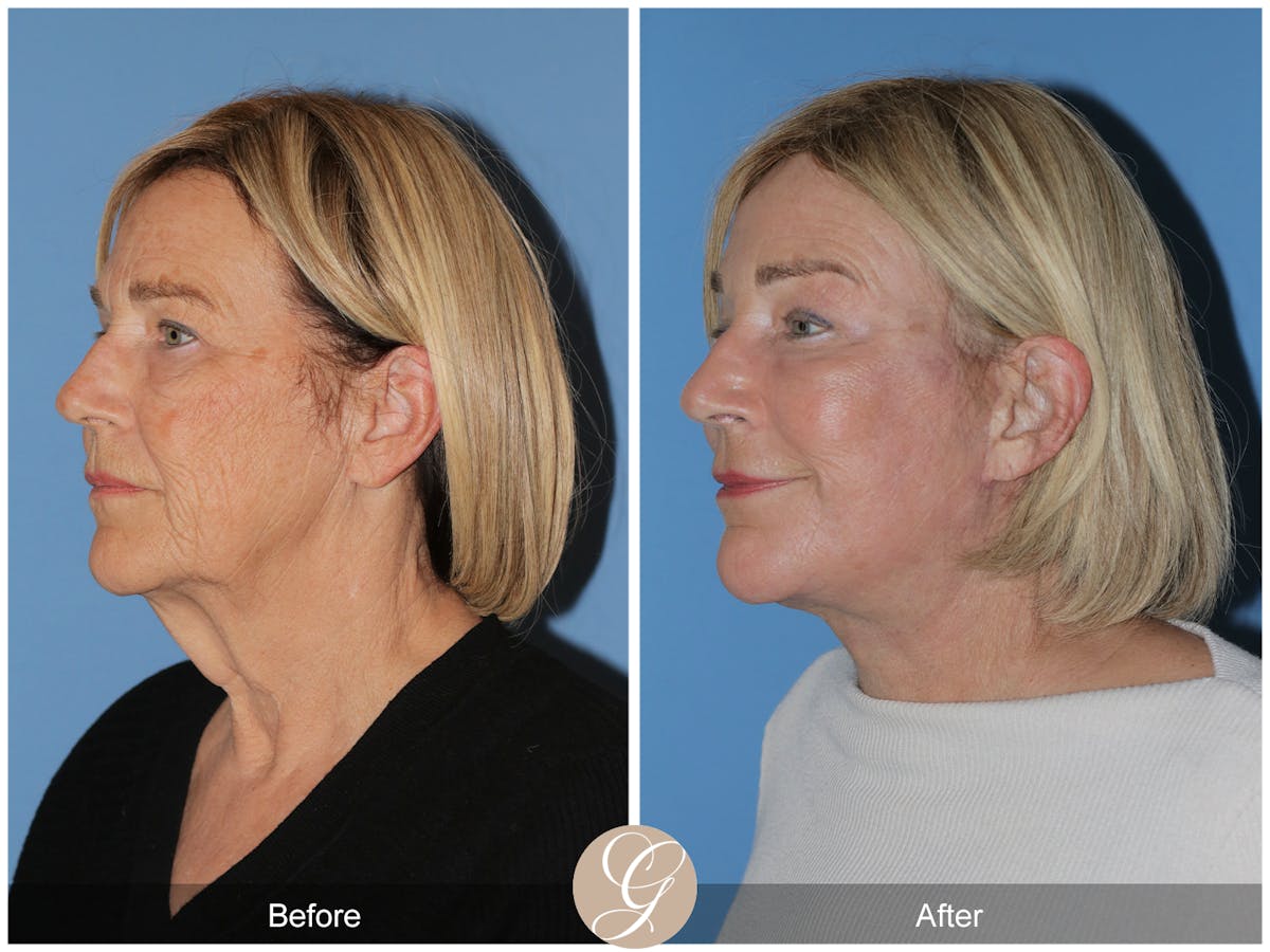 Preservation Facelift Before & After Gallery - Patient 332754 - Image 7