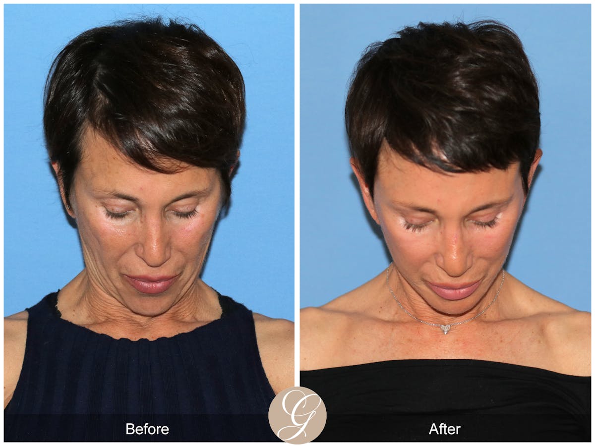 Preservation Facelift Before & After Gallery - Patient 189067 - Image 4