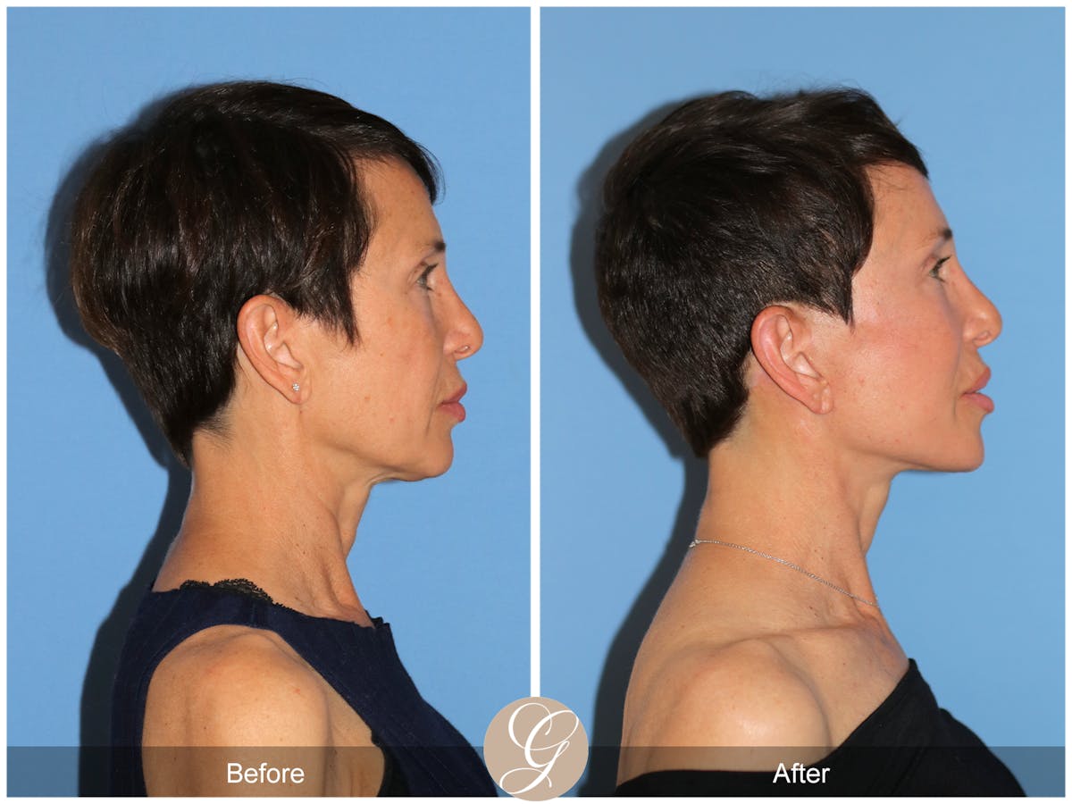 Preservation Facelift Before & After Gallery - Patient 189067 - Image 3