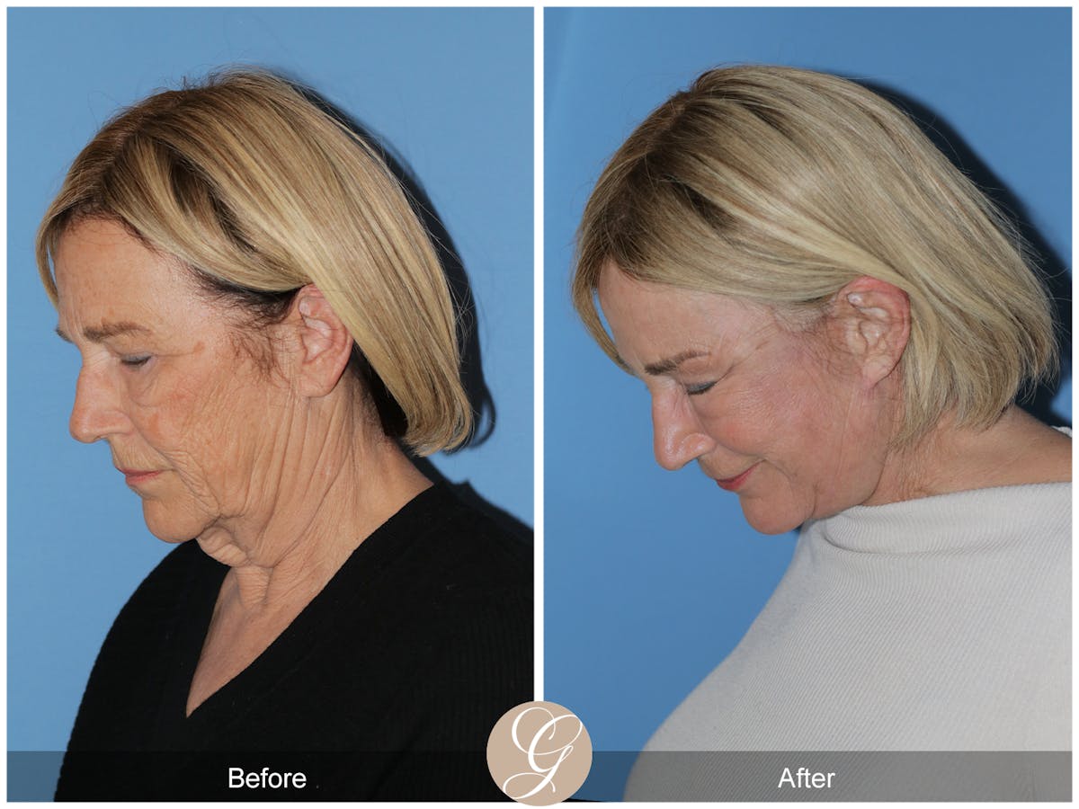Preservation Facelift Before & After Gallery - Patient 332754 - Image 10
