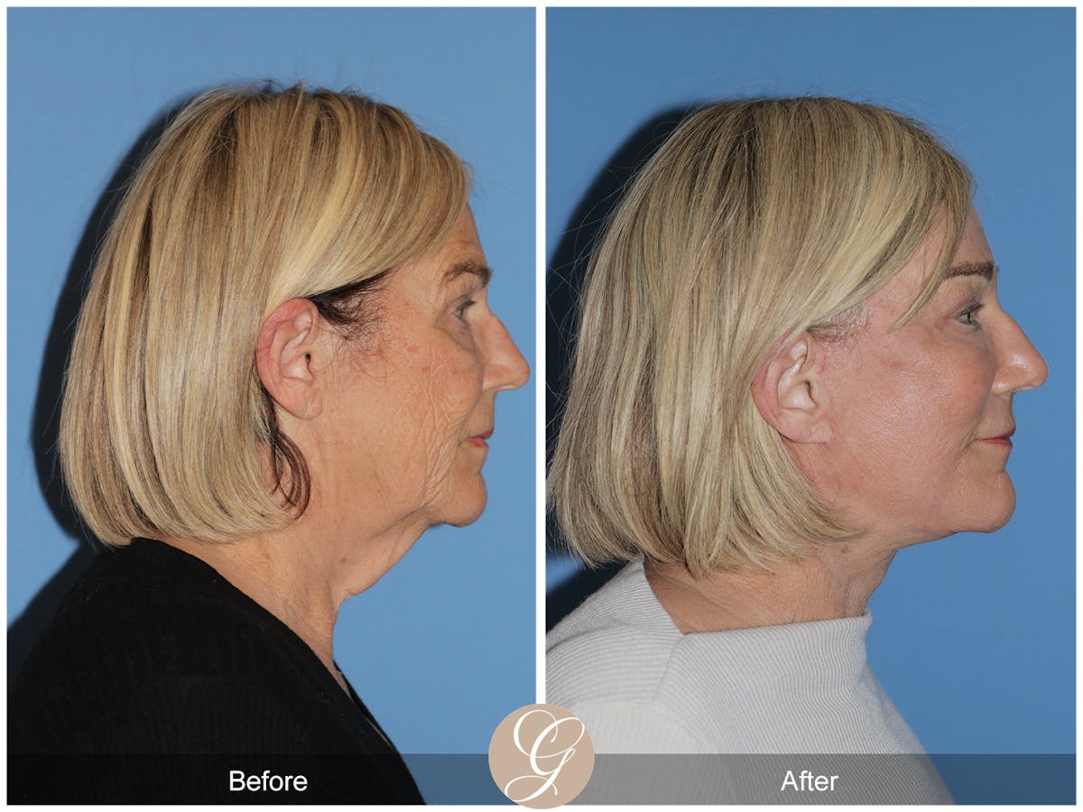 Preservation Facelift Before & After Gallery - Patient 332754 - Image 9