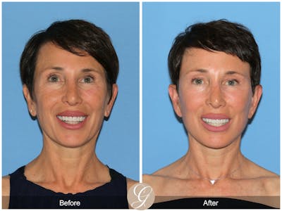 Preservation Facelift Before & After Gallery - Patient 189067 - Image 1
