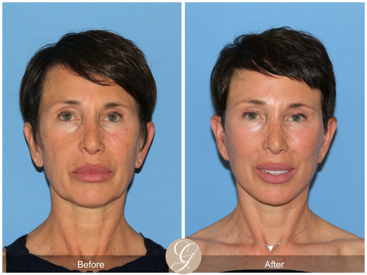 Preservation Facelift Before & After Gallery - Patient 189067 - Image 2
