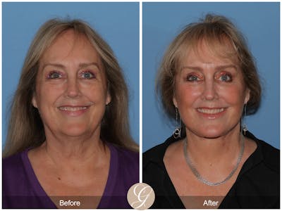 Preservation Facelift Before & After Gallery - Patient 235740 - Image 1