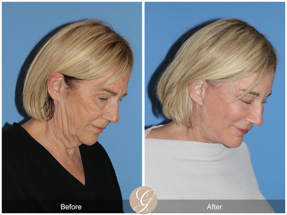 Preservation Facelift Before & After Gallery - Patient 332754 - Image 8