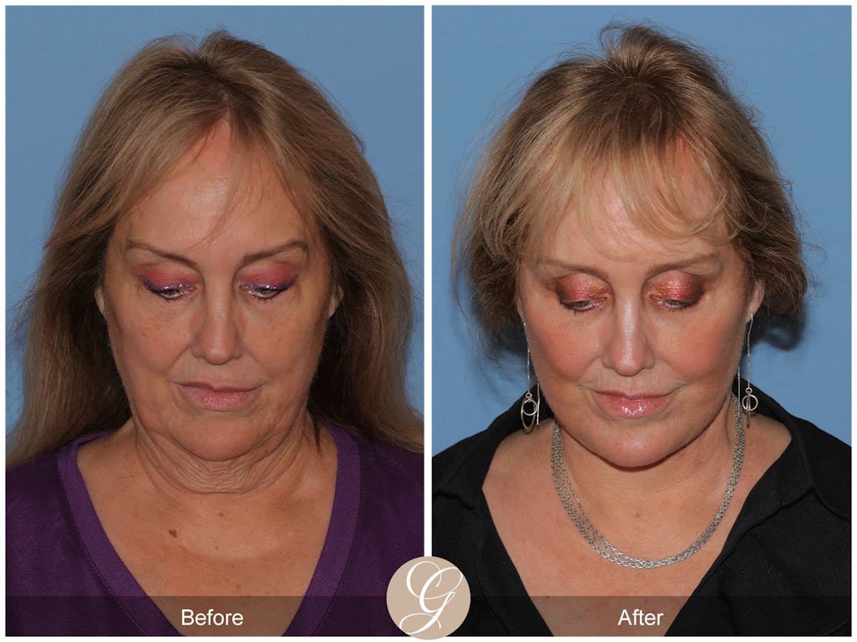 Preservation Facelift Before & After Gallery - Patient 235740 - Image 9