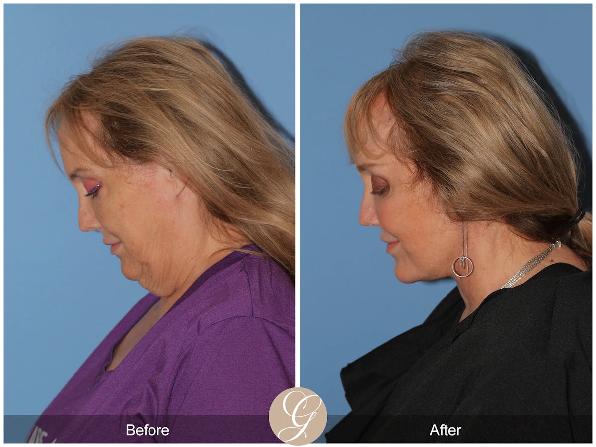 Preservation Facelift Before & After Gallery - Patient 235740 - Image 8