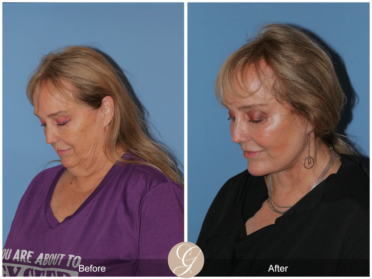 Preservation Facelift Before & After Gallery - Patient 235740 - Image 3