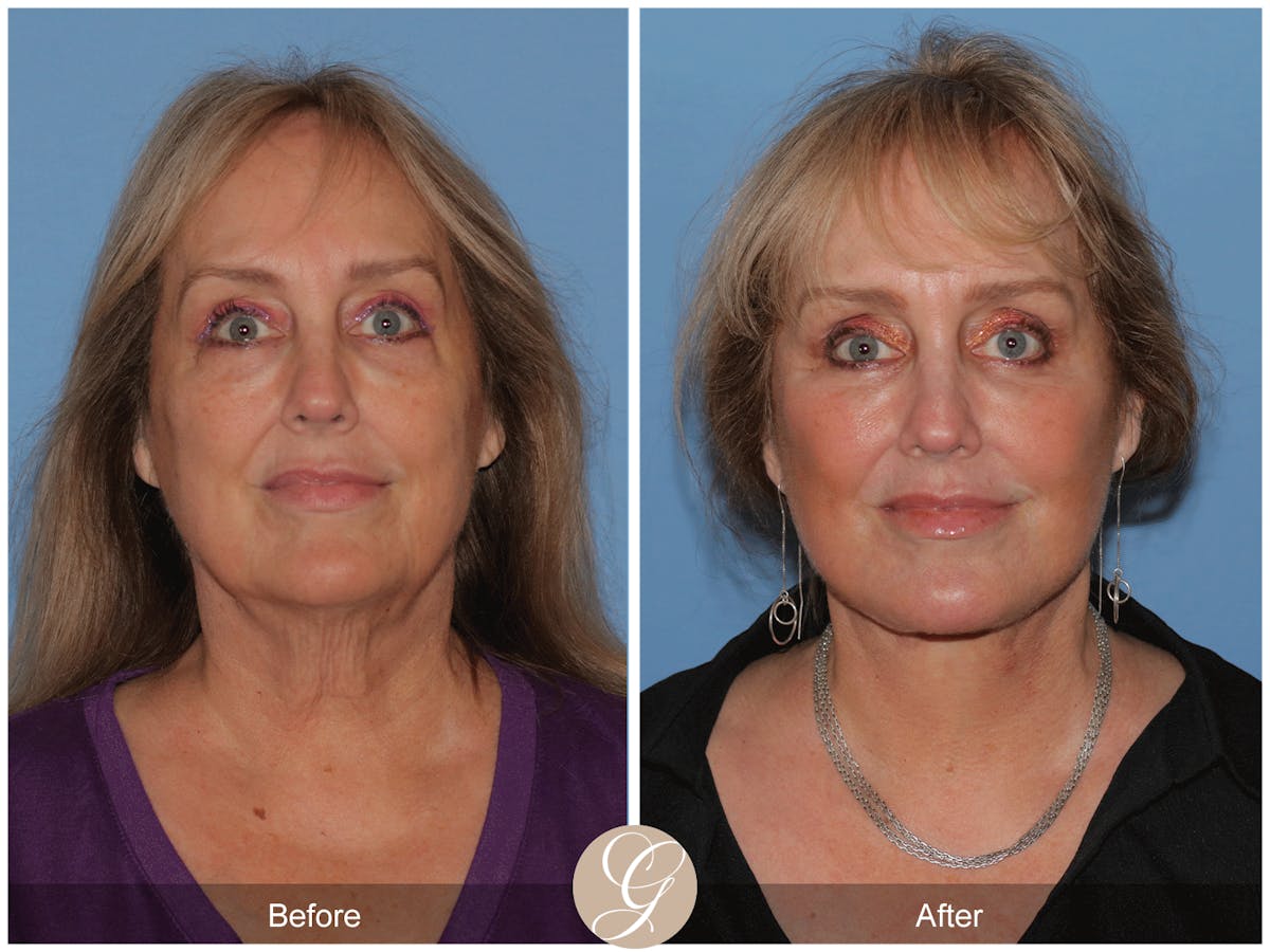 Preservation Facelift Before & After Gallery - Patient 235740 - Image 5