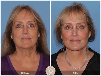 Deep Plane Facelift Before & After Gallery - Patient 681996 - Image 1