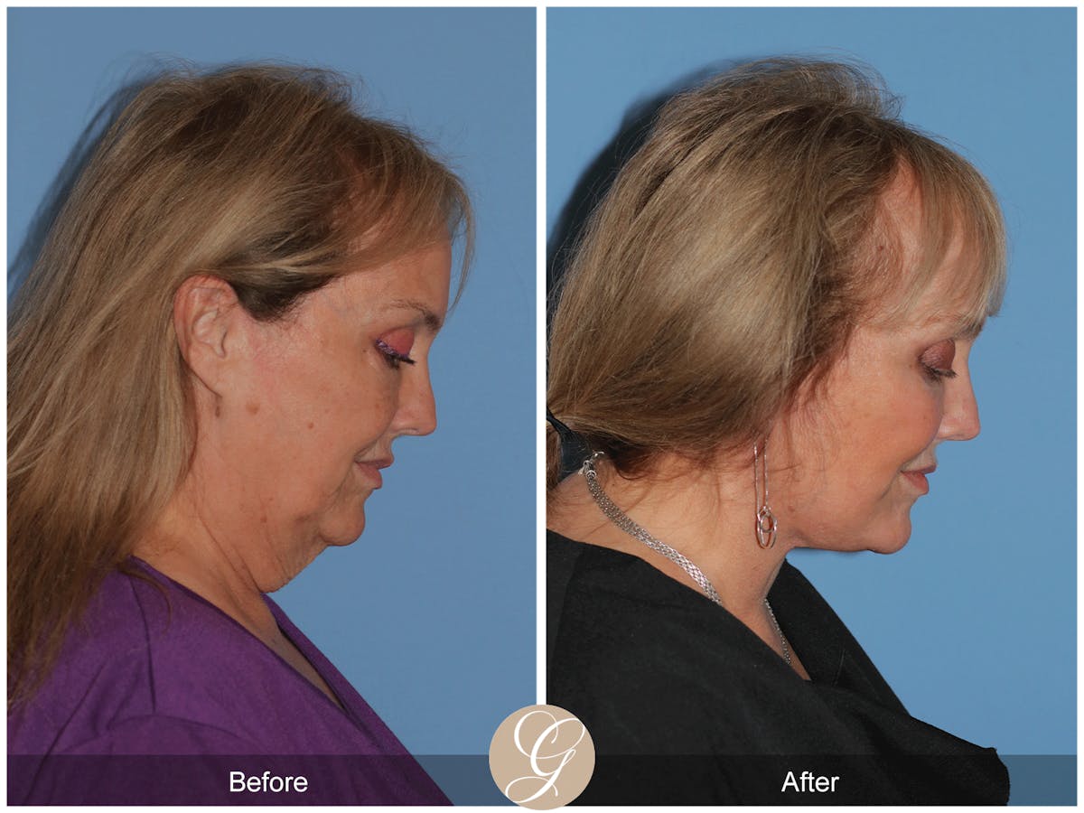 Preservation Facelift Before & After Gallery - Patient 235740 - Image 11
