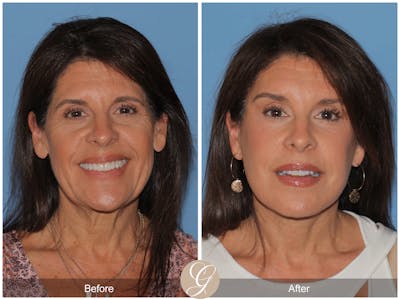 Preservation Facelift Before & After Gallery - Patient 128927 - Image 1