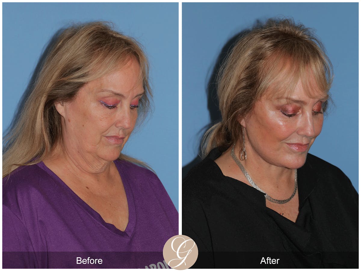 Preservation Facelift Before & After Gallery - Patient 235740 - Image 4