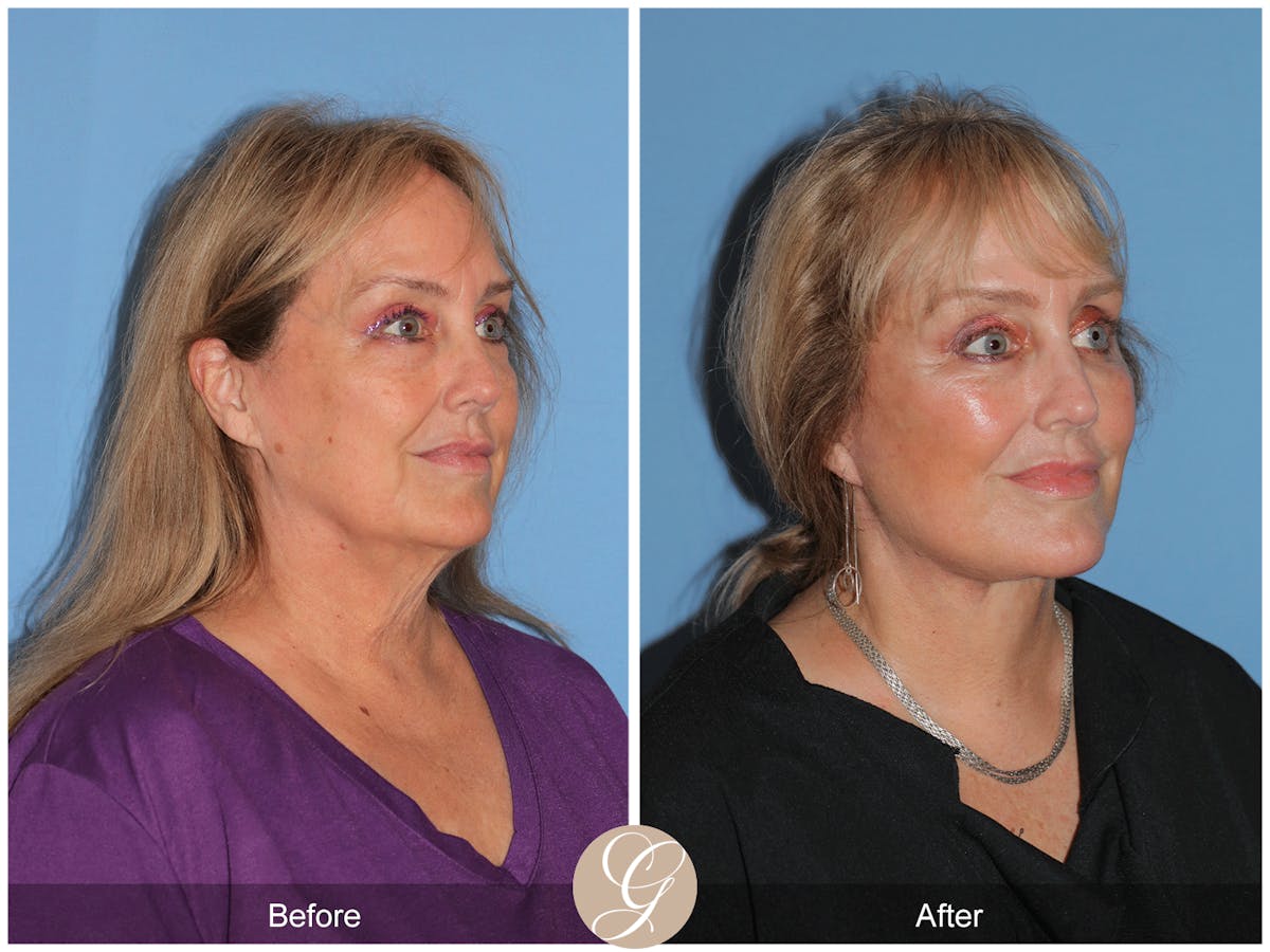 Preservation Facelift Before & After Gallery - Patient 235740 - Image 10