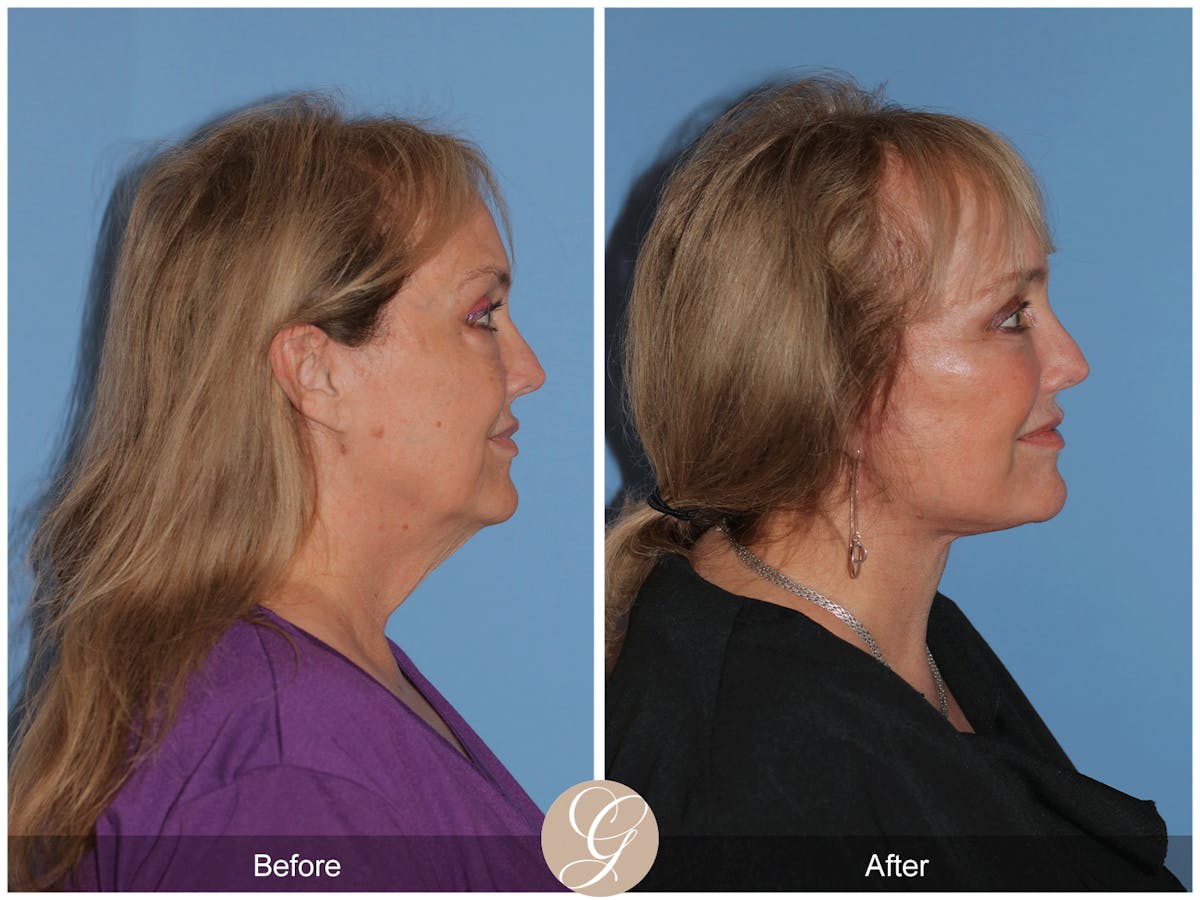 Preservation Facelift Before & After Gallery - Patient 235740 - Image 6