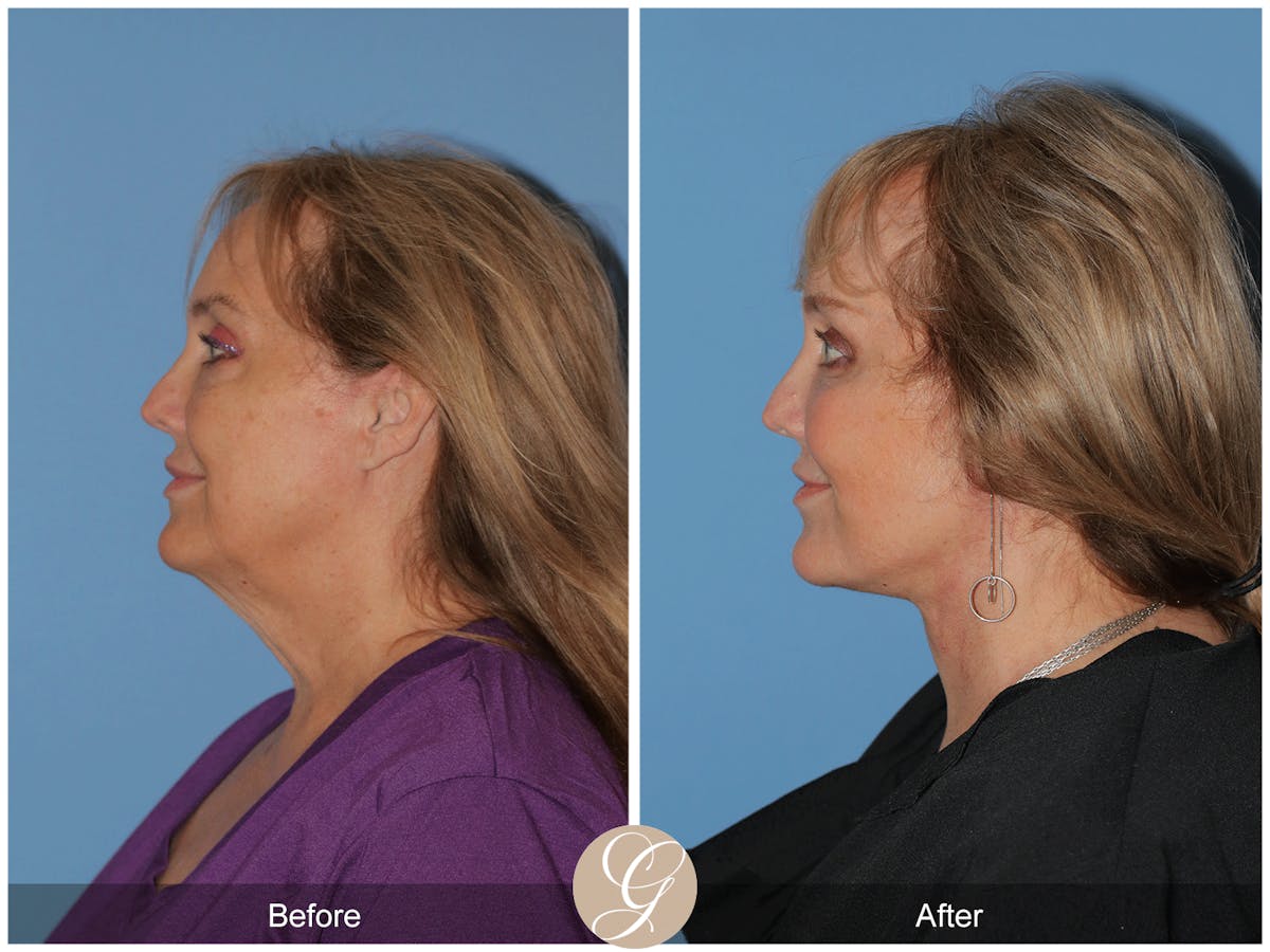 Preservation Facelift Before & After Gallery - Patient 235740 - Image 7