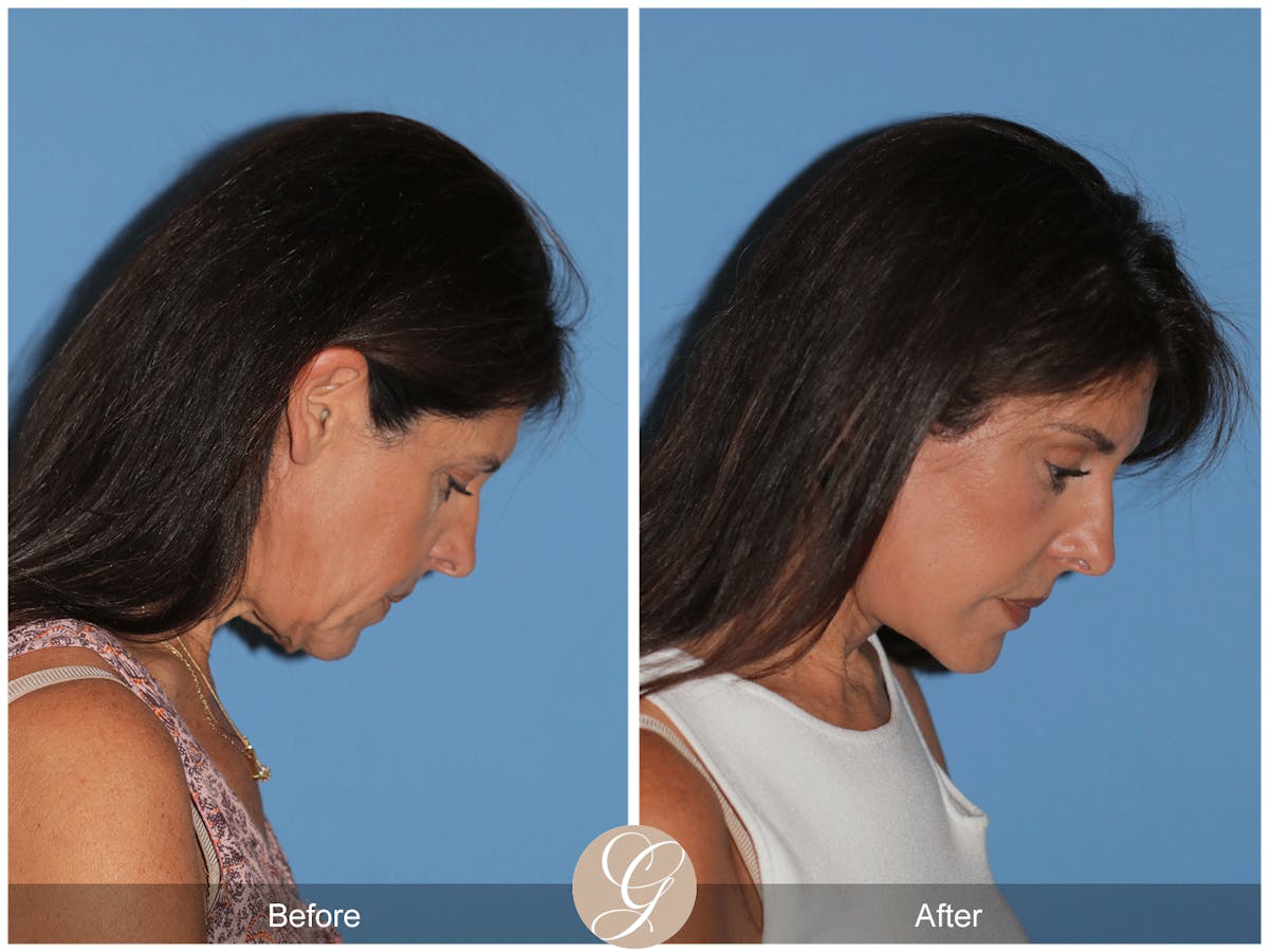 Preservation Facelift Before & After Gallery - Patient 128927 - Image 11