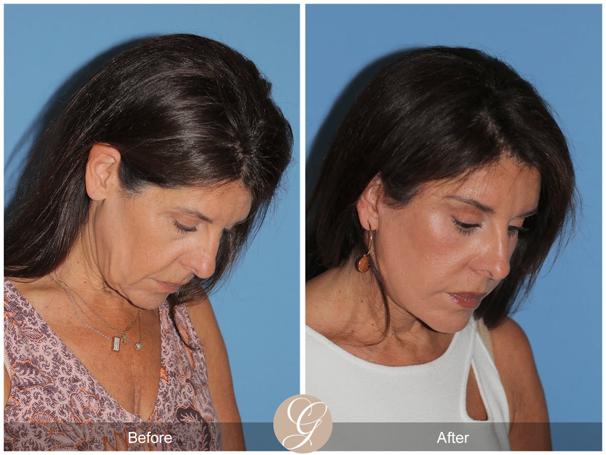 Preservation Facelift Before & After Gallery - Patient 128927 - Image 6