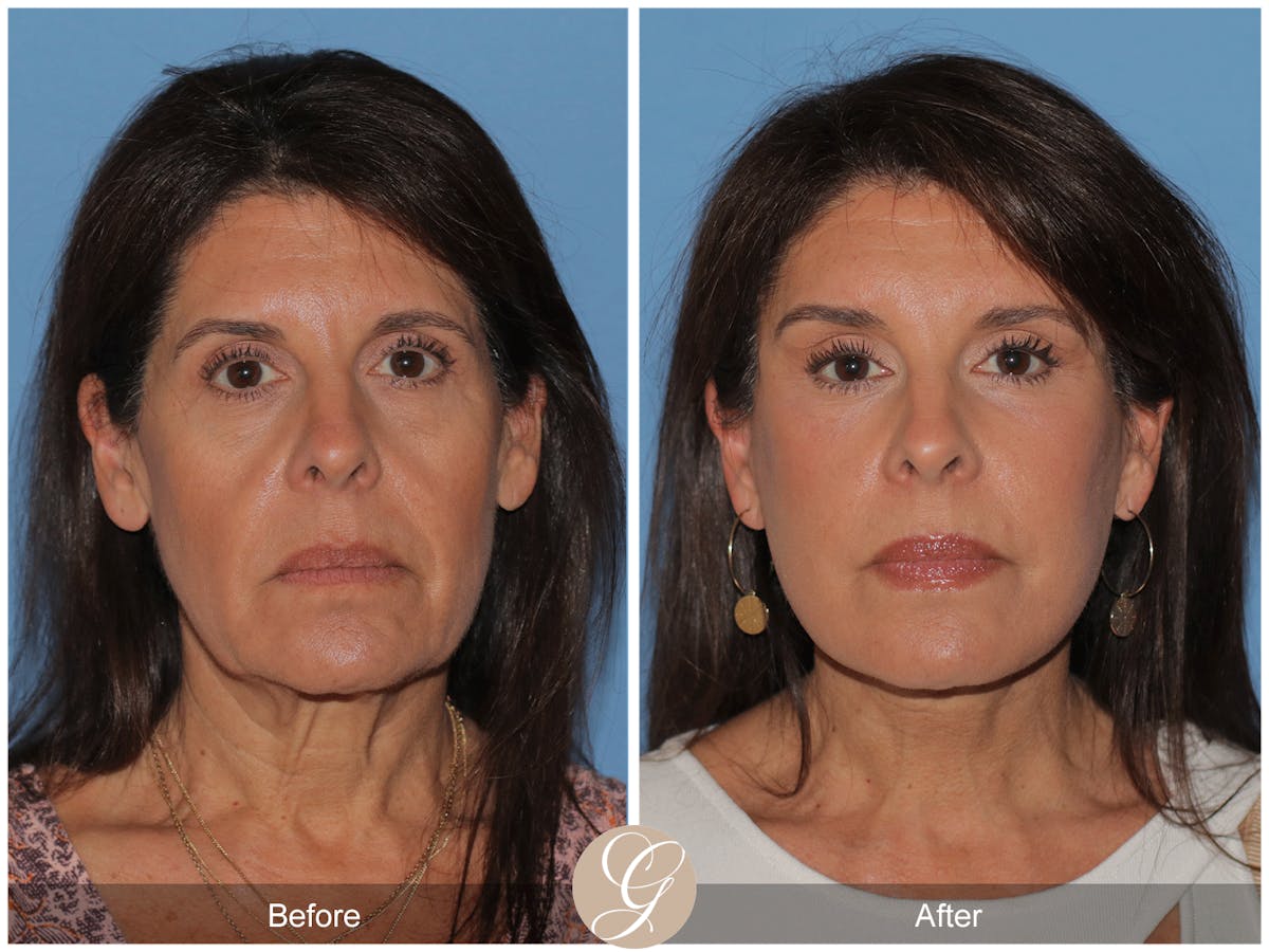 Preservation Facelift Before & After Gallery - Patient 128927 - Image 8
